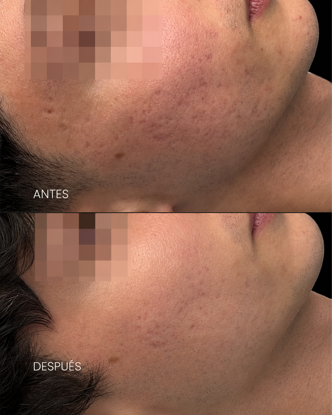 Antes y después — Acné facial