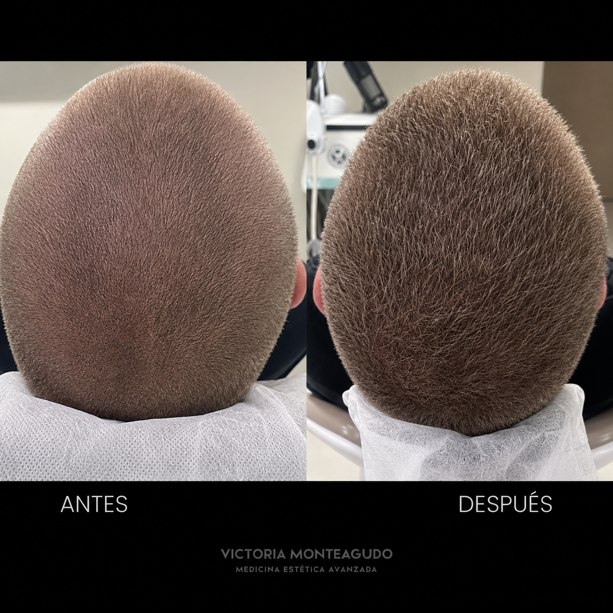 Antes y después — PRP capilar