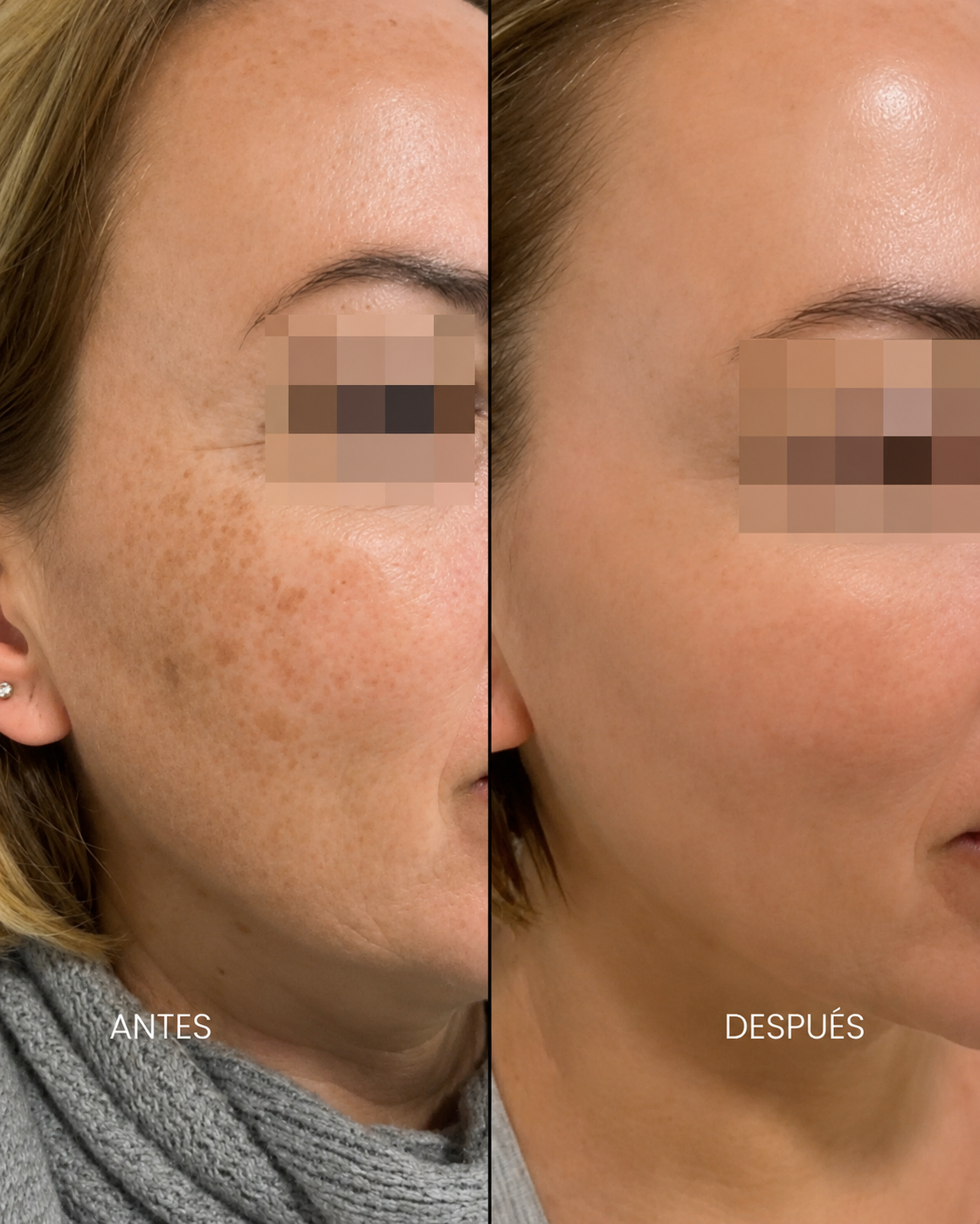 Antes y después — Manchas faciales