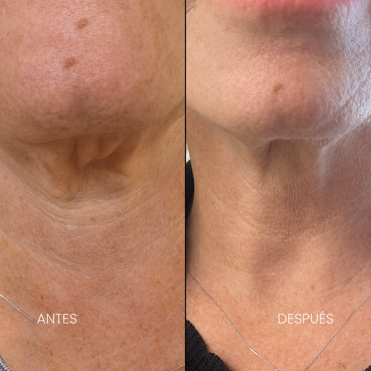 Antes y después — Antiaging cuello