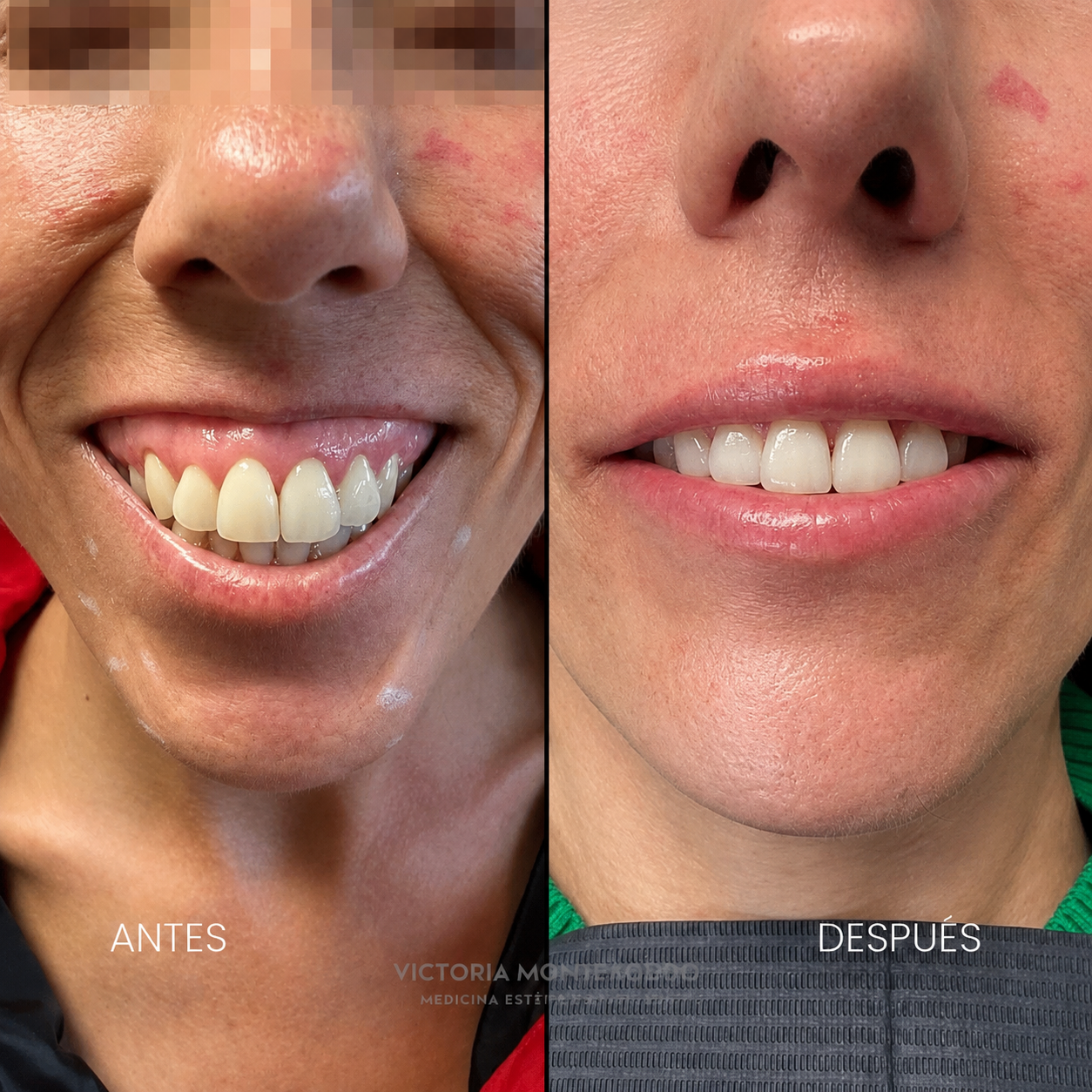Antes y después — Sonrisa y labios