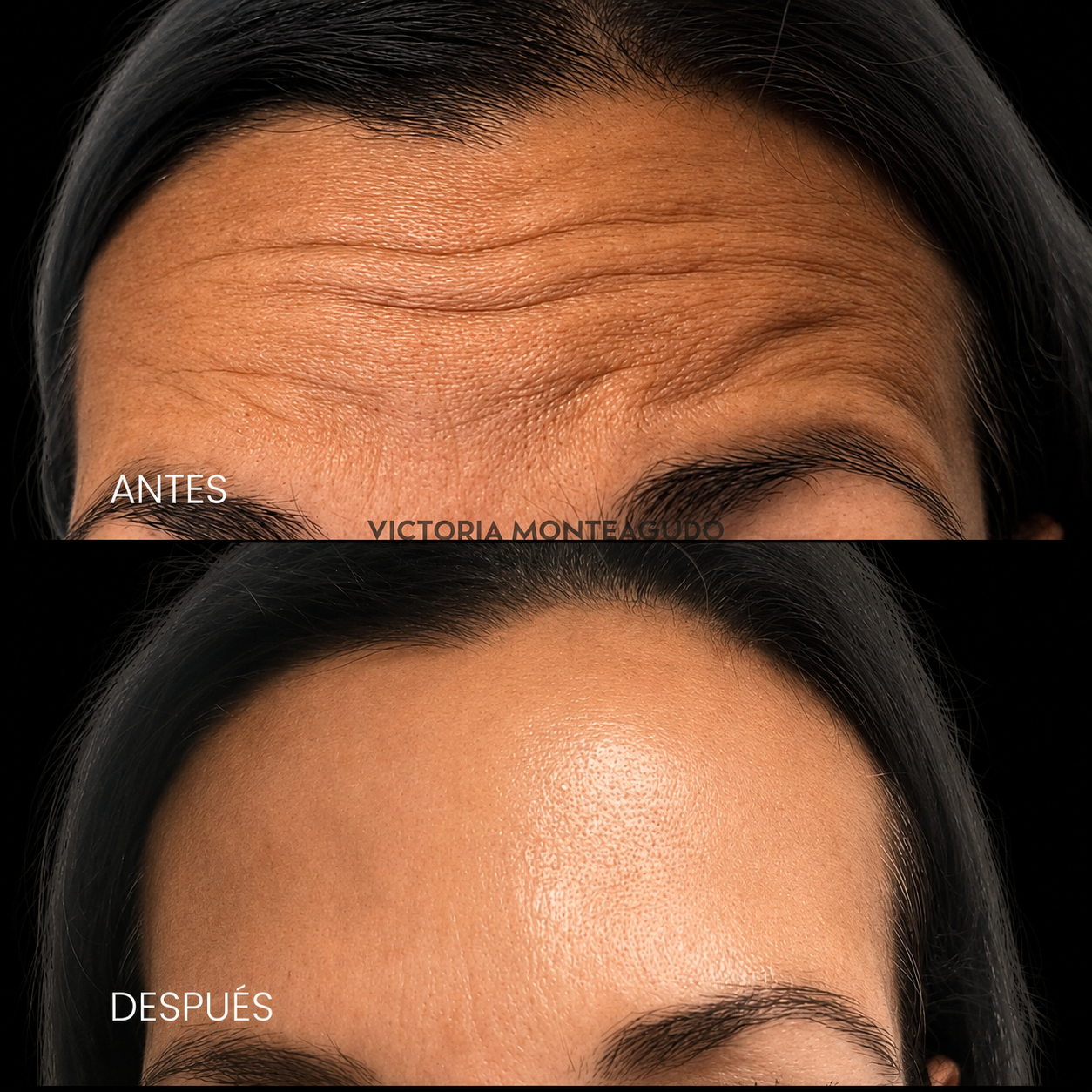Antes y después — Antiaging frente