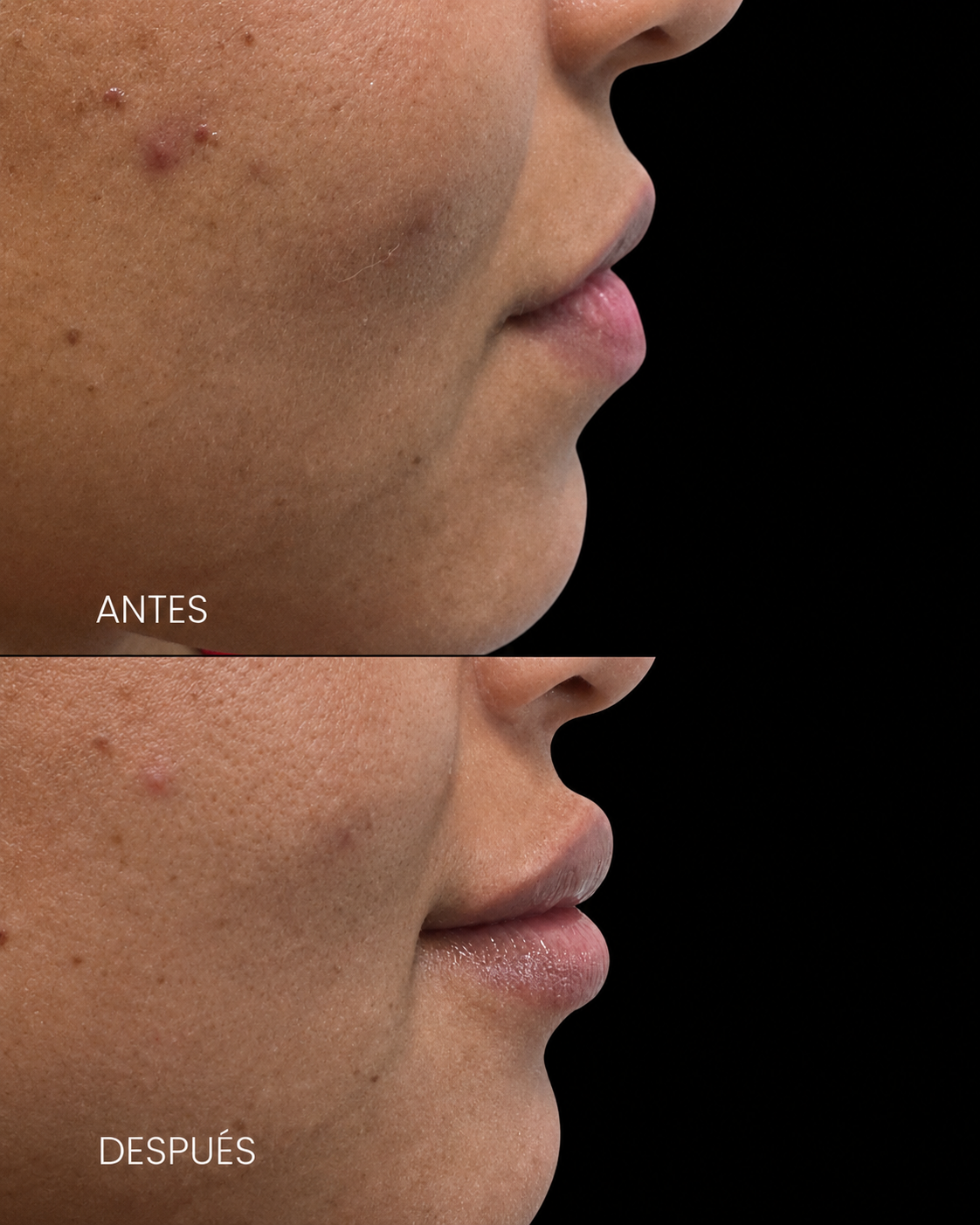 Antes y después — Acné y piel